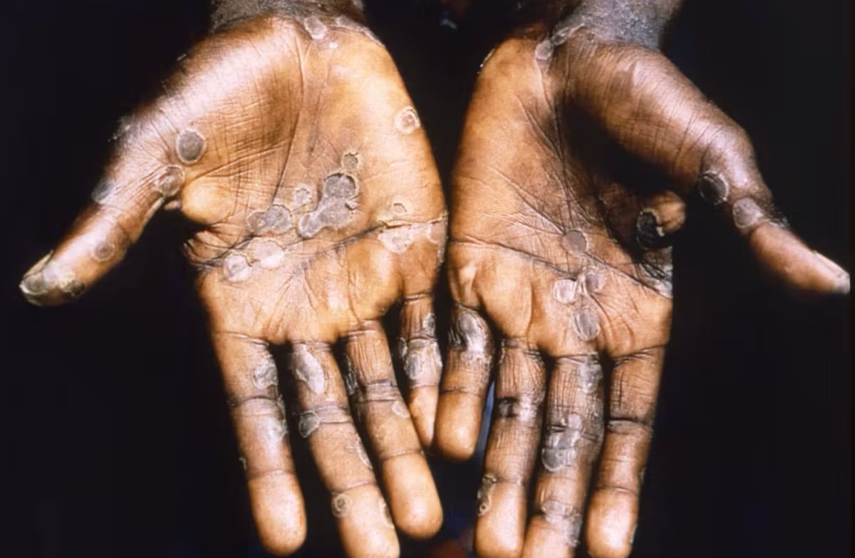 The palms of a patient during an outbreak of mpox in the Democratic Republic of Congo in 1997.